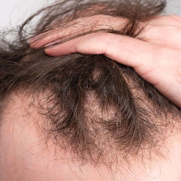 Hair Loss: What You Need to Know?